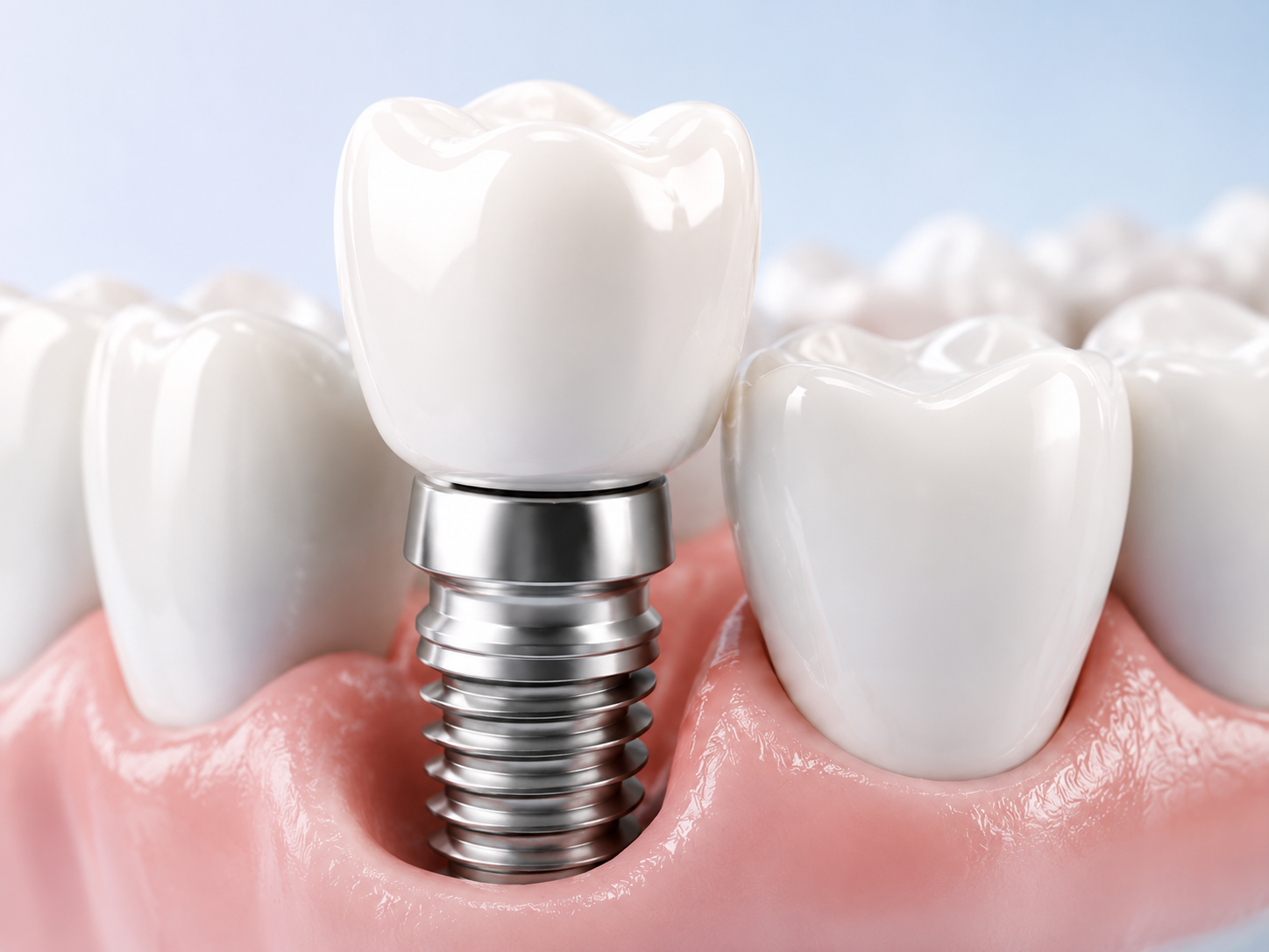 Dental İmplant tedavisi görseli